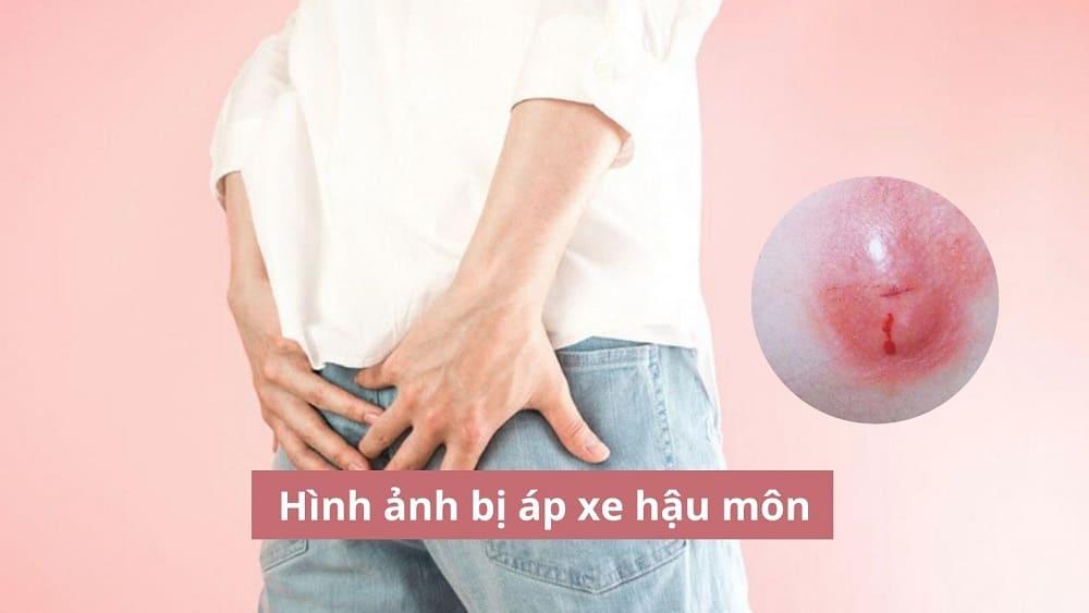 Nhận biết hình ảnh bị áp xe hậu môn