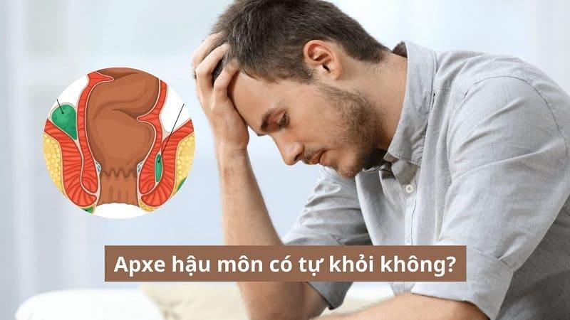 Áp xe hậu môn có tự khỏi không? - Giải đáp từ chuyên gia