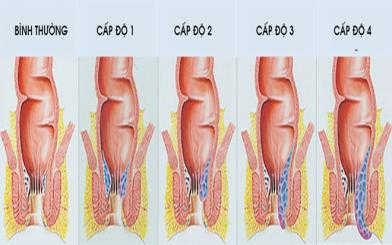 Các cấp độ bệnh trĩ bạn không nên bỏ qua