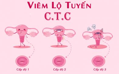 Viêm lộ tuyến cổ tử cung, nguyên nhân, triệu chứng và cách điều trị