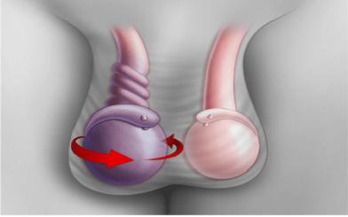 Nam giới bị tinh hoàn bên to bên nhỏ có sao không?