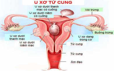 U xơ cổ tử cung là gì, nguyên nhân, triệu chứng và cách điều trị