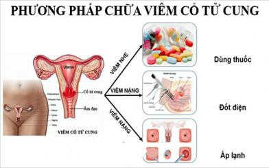 Tiết lộ cách chữa viêm cổ tử cung hiệu quả