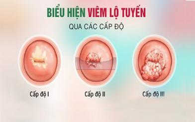 Điều trị viêm lộ tuyến cổ tử cung cấp độ 3 nhanh chóng, hiệu quả