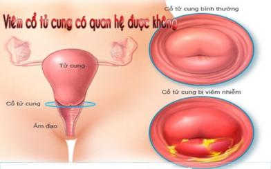 Tại sao bị viêm cổ tử cung khi chưa quan hệ?