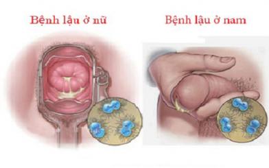 Bệnh lậu có những phương pháp điều trị nào hiệu quả?