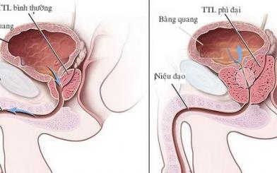 Bệnh phì đại tuyến tiền liệt và cách điều trị hiệu quả