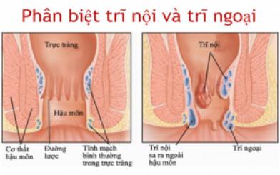 Phân biệt trĩ nội và trĩ ngoại - Cách chữa trị hiệu quả