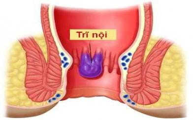 Dấu hiệu bệnh trĩ nội: Nhận biết sớm, điều trị ngay