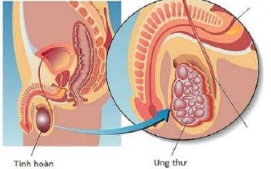 Ung thư tinh hoàn: Nguyên nhân, triệu chứng và cách điều trị