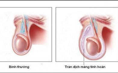 Tràn dịch màng tinh hoàn có nguy hiểm không? Điều trị bao lâu thì khỏi?