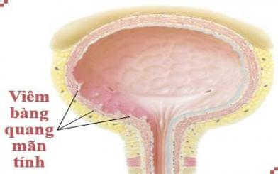 Viêm bàng quang mãn tính và cách điều trị không lo tái phát