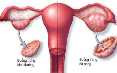 Buồng trứng đa nang có nguy hiểm không – chuyên gia giải đáp