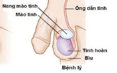 Bệnh nang mào tinh hoàn – Chớ dại mà xem thường!