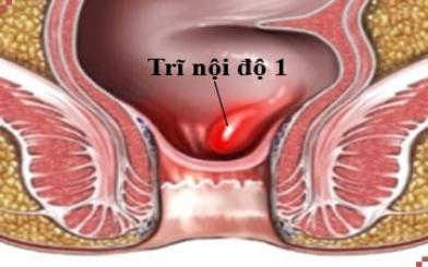 Bệnh trĩ nội độ 1: Nguyên nhân, triệu chứng và cách chữa dứt điểm