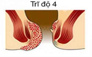 [Chia sẻ] Phương pháp điều trị trĩ độ 4 hiệu quả nhất hiện nay