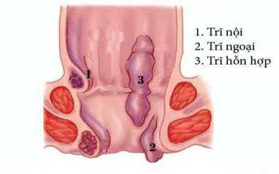 [Tổng hợp] Cách chữa trĩ “nổi tiếng” hiệu quả, không tái phát