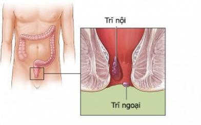 [Bật mí] Cách chữa bệnh trĩ như thế nào an toàn, hiệu quả