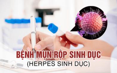 Mụn rộp sinh dục là gì? Triệu chứng và cách điều trị tích cực