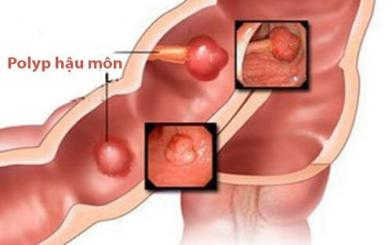 Polyp hậu môn bệnh học là gì? Cách điều trị triệt để