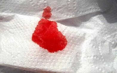Đi ngoài ra máu sau cắt trĩ: Nguyên nhân và biện pháp khắc phục