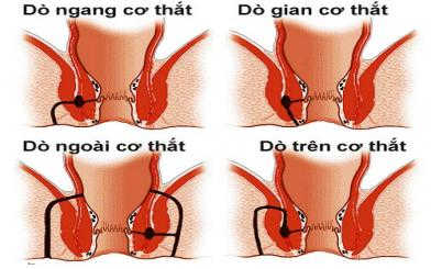 Rò hậu môn bệnh học: Nguyên nhân, triệu chứng, cách điều trị