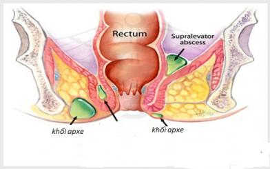 Rò hậu môn thành áp xe: Điều trị càng sớm càng tốt
