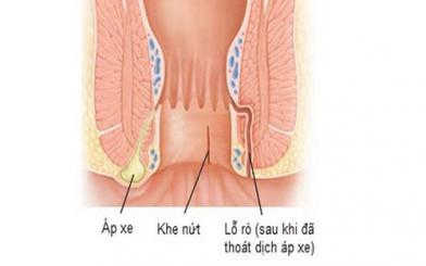 Áp xe rò hậu môn – bệnh lý biến chứng nguy hiểm tính mạng!