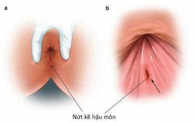 Nứt kẽ hậu môn nặng tự điều trị tại nhà được không?