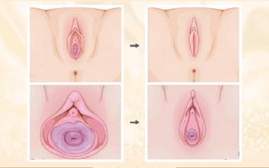 Phẫu thuật vùng kín – Bí quyết giữ lửa tình yêu