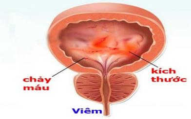 Viêm bọng đái là gì? Nguyên nhân và cách điều trị 