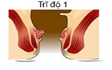 Bệnh trĩ nội cấp độ 1 và 6 cách chữa tại nhà