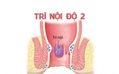 Trĩ nội độ 2 có chữa được không? Cách chữa tốt nhất