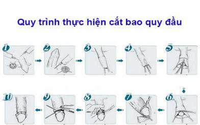 Quá trình cắt bao quy đầu với 5 bước đơn giản, hiệu quả