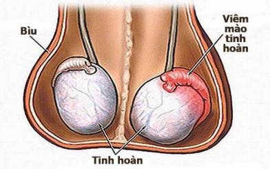 10 nguyên nhân đau ở tinh hoàn phải và cách điều trị