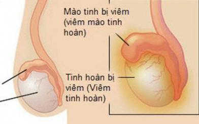 Vì sao viêm tinh hoàn mãn tính và cách khắc phục 