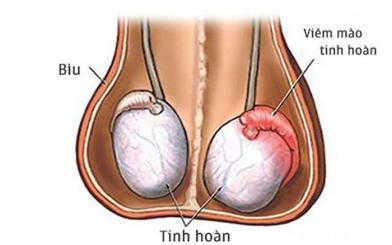 Đau tinh hoàn phải và bụng dưới: Dấu hiệu 9 bệnh nam khoa nguy hiểm