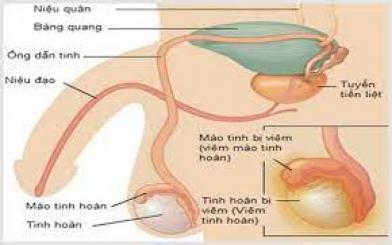 [ Thực hư ] Điều trị viêm tinh hoàn tại nhà hiệu quả