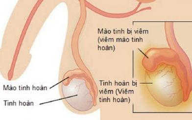 Viêm mào tinh hoàn nên ăn gì và kiêng ăn gì nhanh khỏi bệnh?