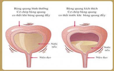 Triệu chứng căng tức bàng quang coi chừng 5 bệnh nguy hiểm