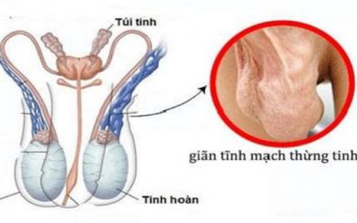 Chữa giãn tĩnh mạch tinh hoàn bằng Đông y có hiệu quả không?