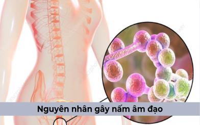 [Tổng hợp] Những nguyên nhân gây nấm âm đạo và cách điều trị dứt điểm 