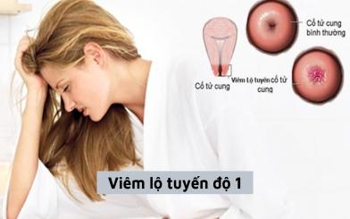 Viêm lộ tuyến độ 1 ở nữ giới là gì? Dấu hiệu và cách chữa hiệu quả