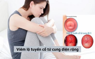 Tìm hiểu về viêm lộ tuyến cổ tử cung diện rộng: Triệu chứng, tác hại và đề xuất phương pháp điều trị