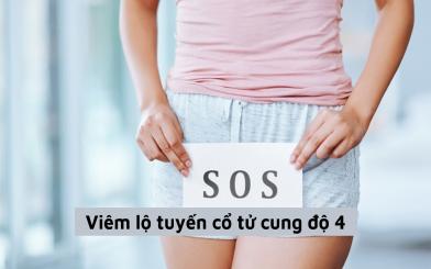 Viêm lộ tuyến cổ tử cung độ 4 có vô sinh không? Chữa được không?