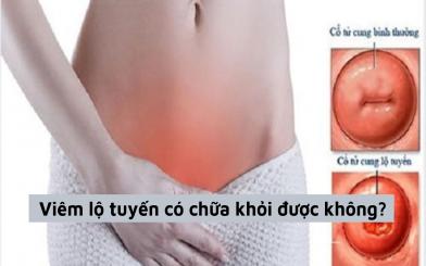 [Giải đáp thắc mắc] Viêm lộ tuyến có chữa khỏi được không?