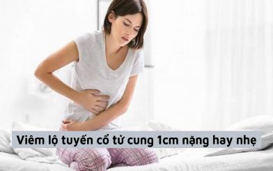 Chị em nữ giới băn khoăn viêm lộ tuyến cổ tử cung 1cm nặng hay nhẹ, nên chữa như thế nào?