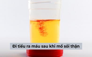 Đi tiểu ra máu sau khi mổ sỏi thận: Nguyên nhân và cách xử lý 