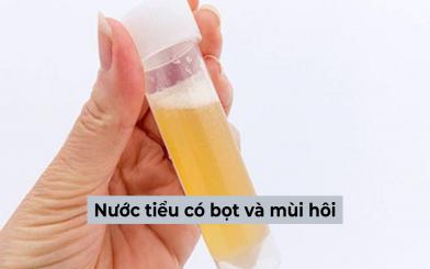 Nước tiểu có bọt và mùi hôi: nguyên nhân và cách cải thiện