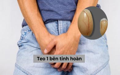 Teo 1 bên tinh hoàn: Nguyên nhân, triệu chứng và cách chữa như thế nào?